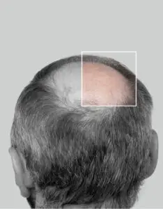 Implante Capilar Hombres - Implante Capilar Medellín - Dharma Hair Colombia