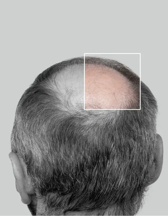 Implante Capilar Hombres - Implante Capilar Medellín - Dharma Hair Colombia