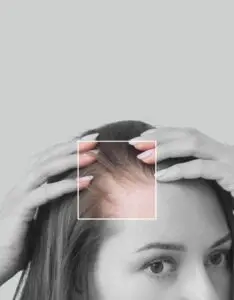Implante Capilar Mujer - Implante Capilar Medellín - Dharma Hair Colombia