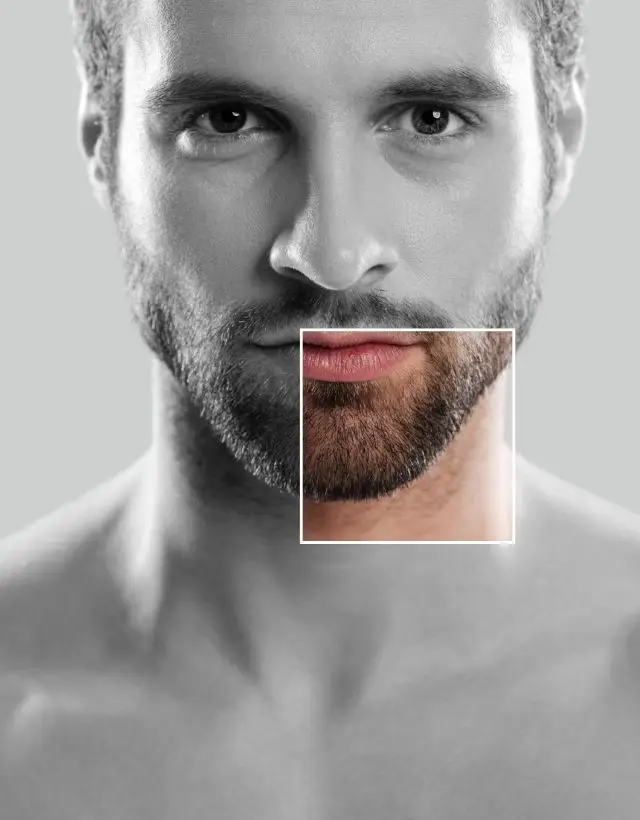 Implante capilar barba - Be Dharma Hair en Medellín