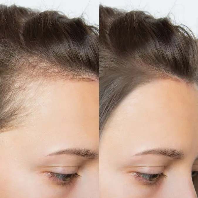 Before and after a women's hair transplant in Medellín