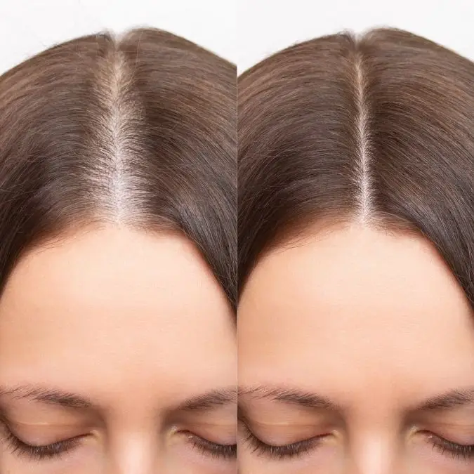Hair transplant for women, before and after in Medellín