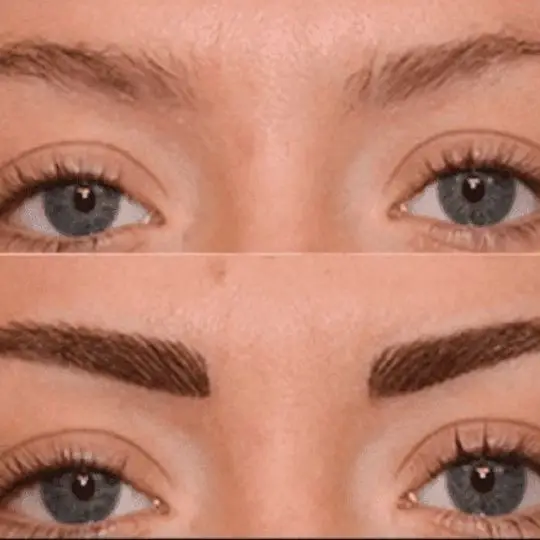 Eyebrow transplant before and after in Medellín — Dharma Hair