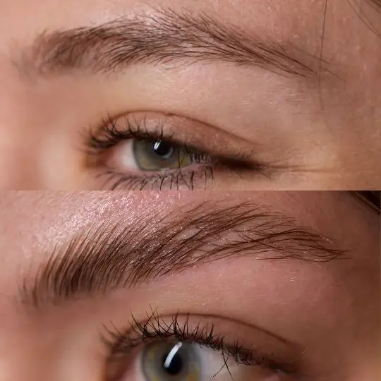 Eyebrow transplant procedure in Medellín — Dharma Hair