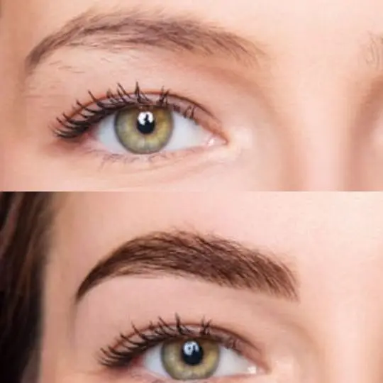 Close-up of eyebrow hair follicle implantation — Dharma Hair