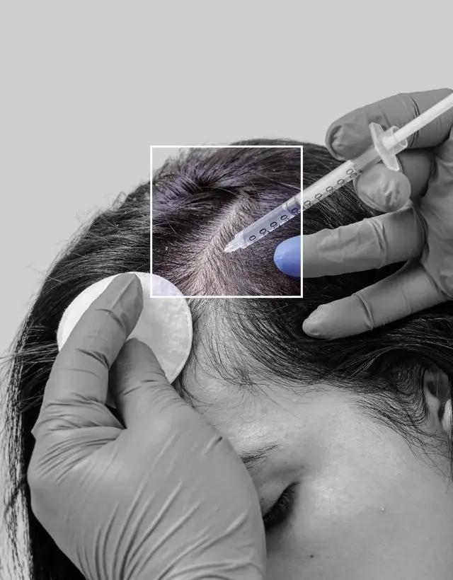 Mesoterapia capilar en Medellín - clínica capilar Dharma Hair