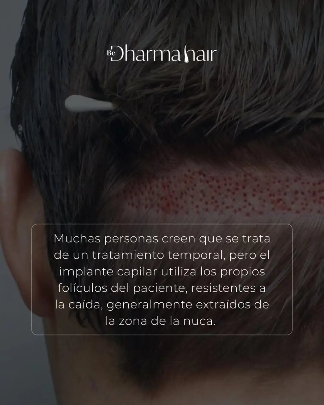 Cuánto tiempo dura un implante capilar - Clínica Dharma hair 2