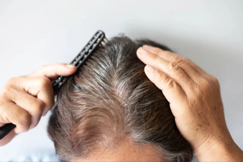 Implante capilar mes a mes - mes 6 Progreso visible - Clínica de implante capilar en Medellín Be Dharma