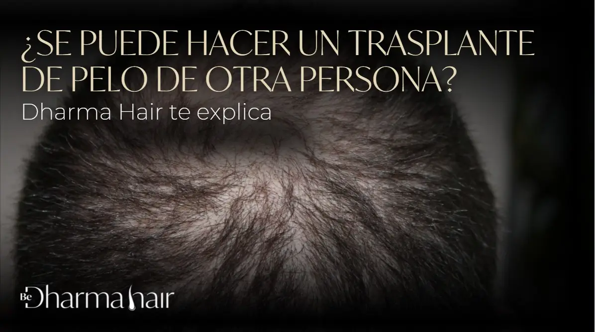 ¿Se puede hacer un trasplante de pelo de otra persona?-Dharma Hair