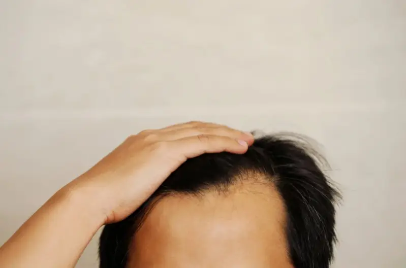 Diseño de cabello hombre - Cirugía de implante capilar en Medellín, Colombia - Dharma Hair