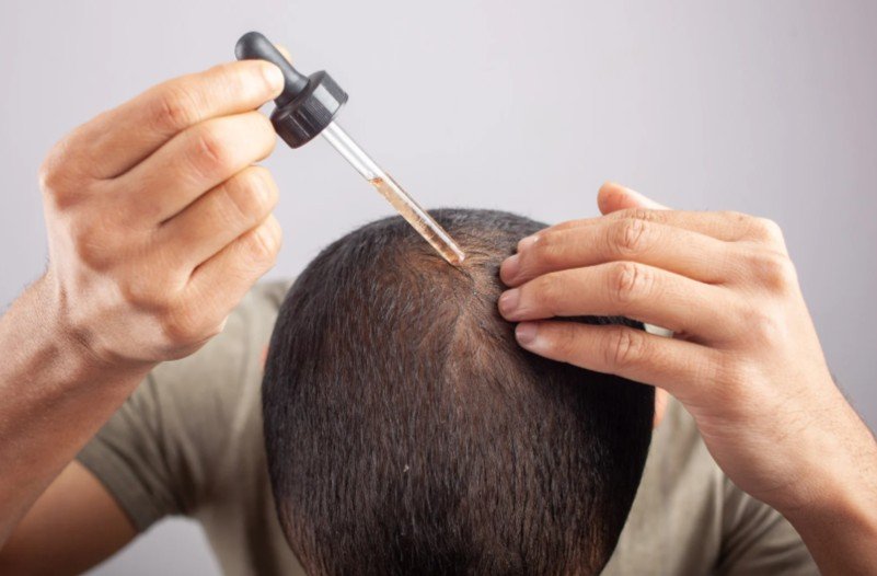 Tratamientos para la caida del cabello - minoxidil topico - clinica Dharma Hair en Medellin