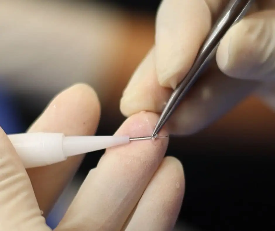 Extracción de folículos con Técnica FUE en Be Dharma Hair en Medellín