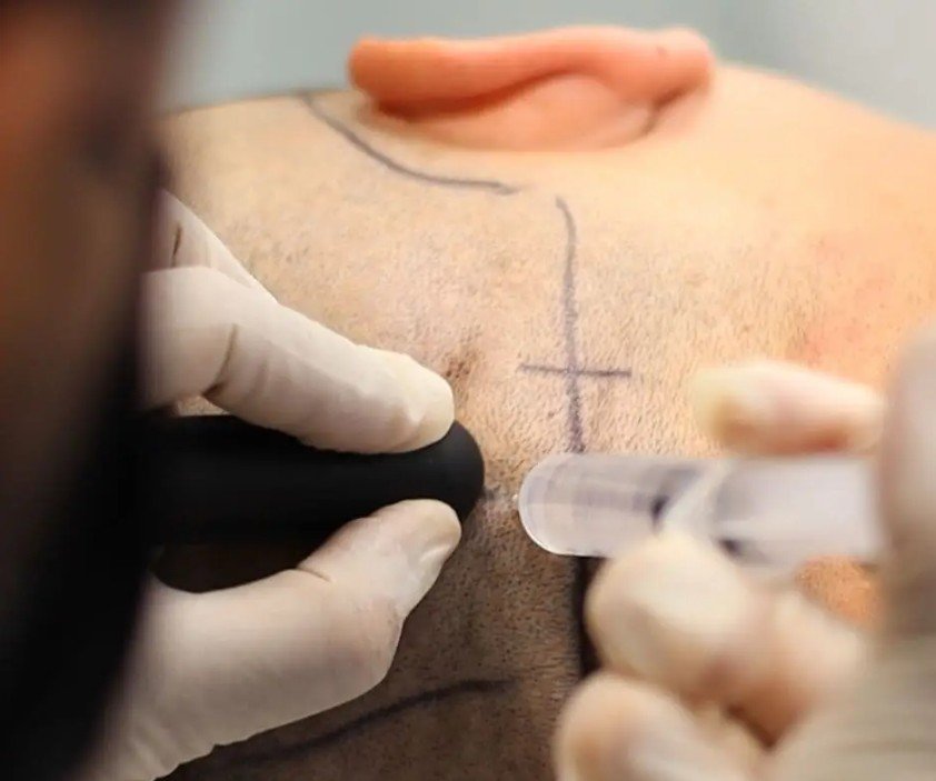 Hair transplant Colombia - Be Dharma hair