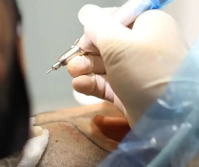 Hair transplant Medellin - Be Dharma hair