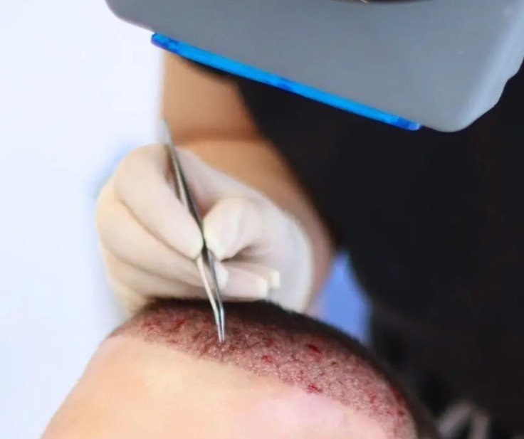 Hair transplant in Medellín - Be Dharma Hair