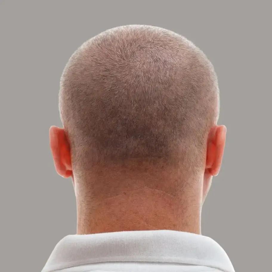 Hair transplant in colombia - Be Dharma Hair - After and before