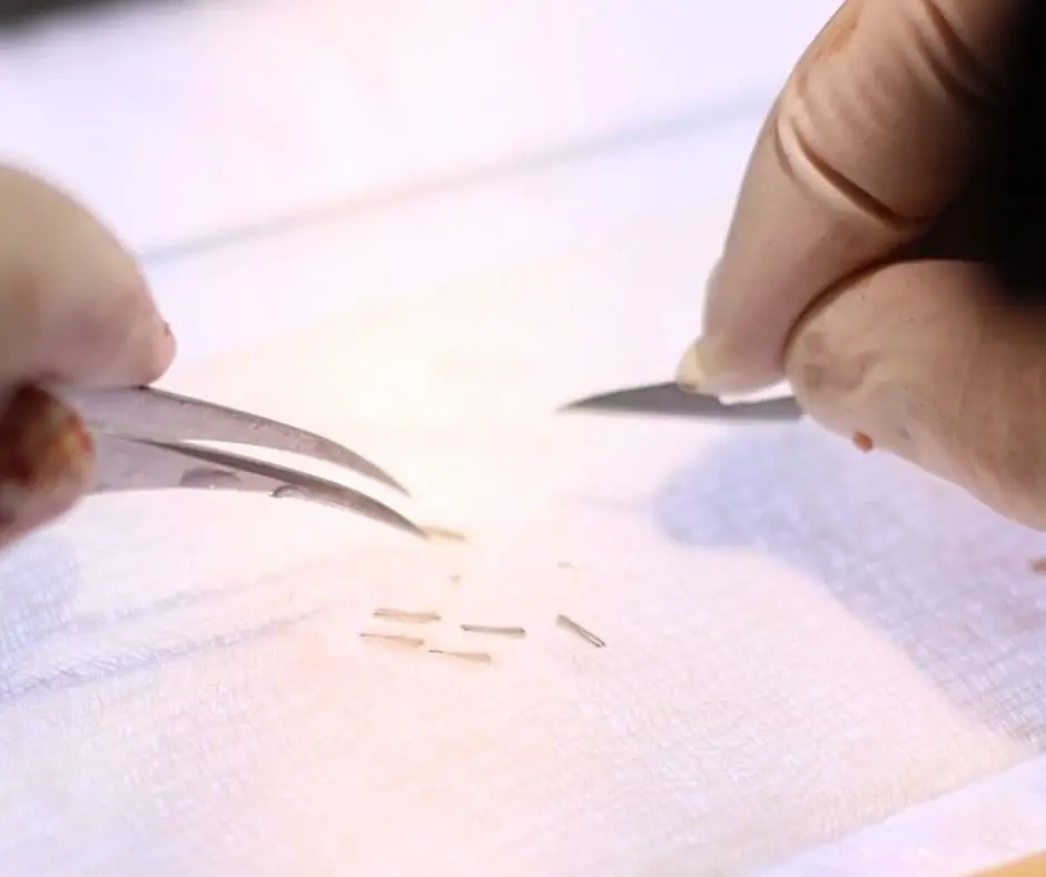 Implante Capilar con Técnica FUE en Medellin