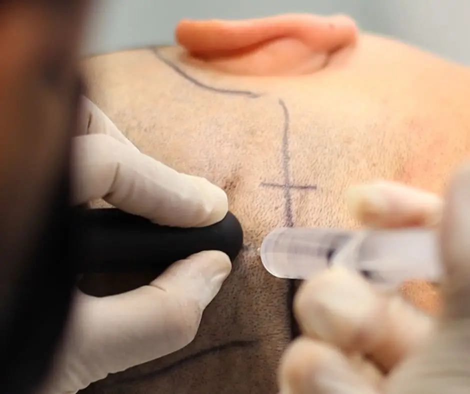 Técnica FUE - Implante Capilar en Medellín - Be Dharma Hair