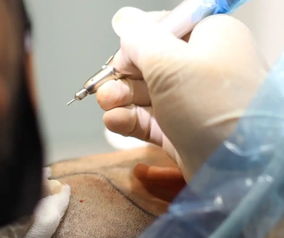 Técnica de Implante Capilar FUE - Be Dharma Hair en Medellín