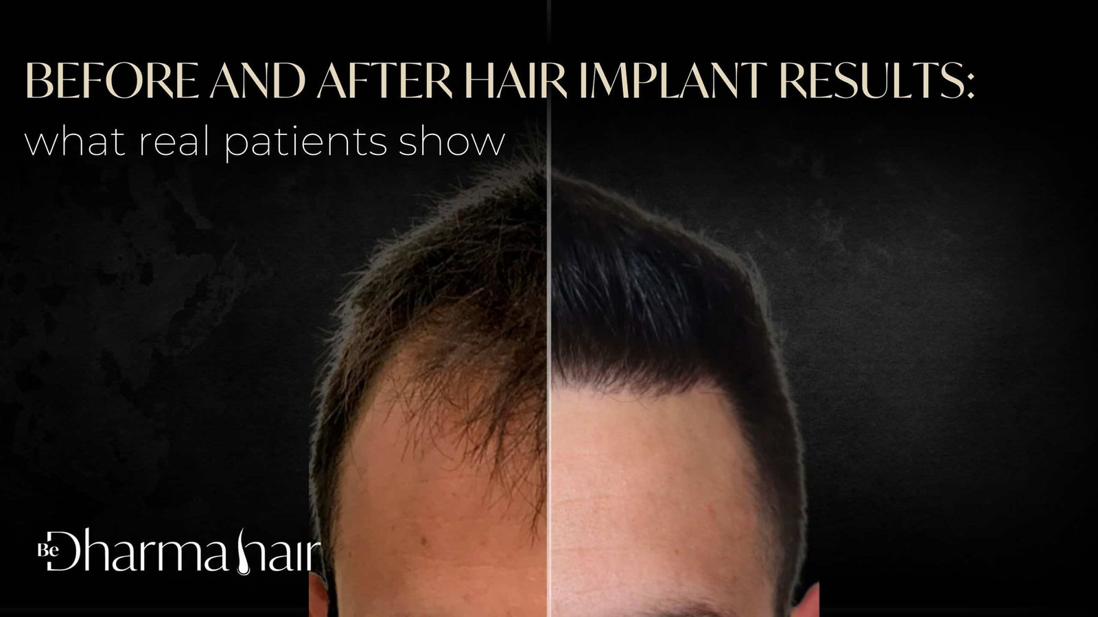 Hair implant results - Be Dharma Hair - Medellín, Colombia
