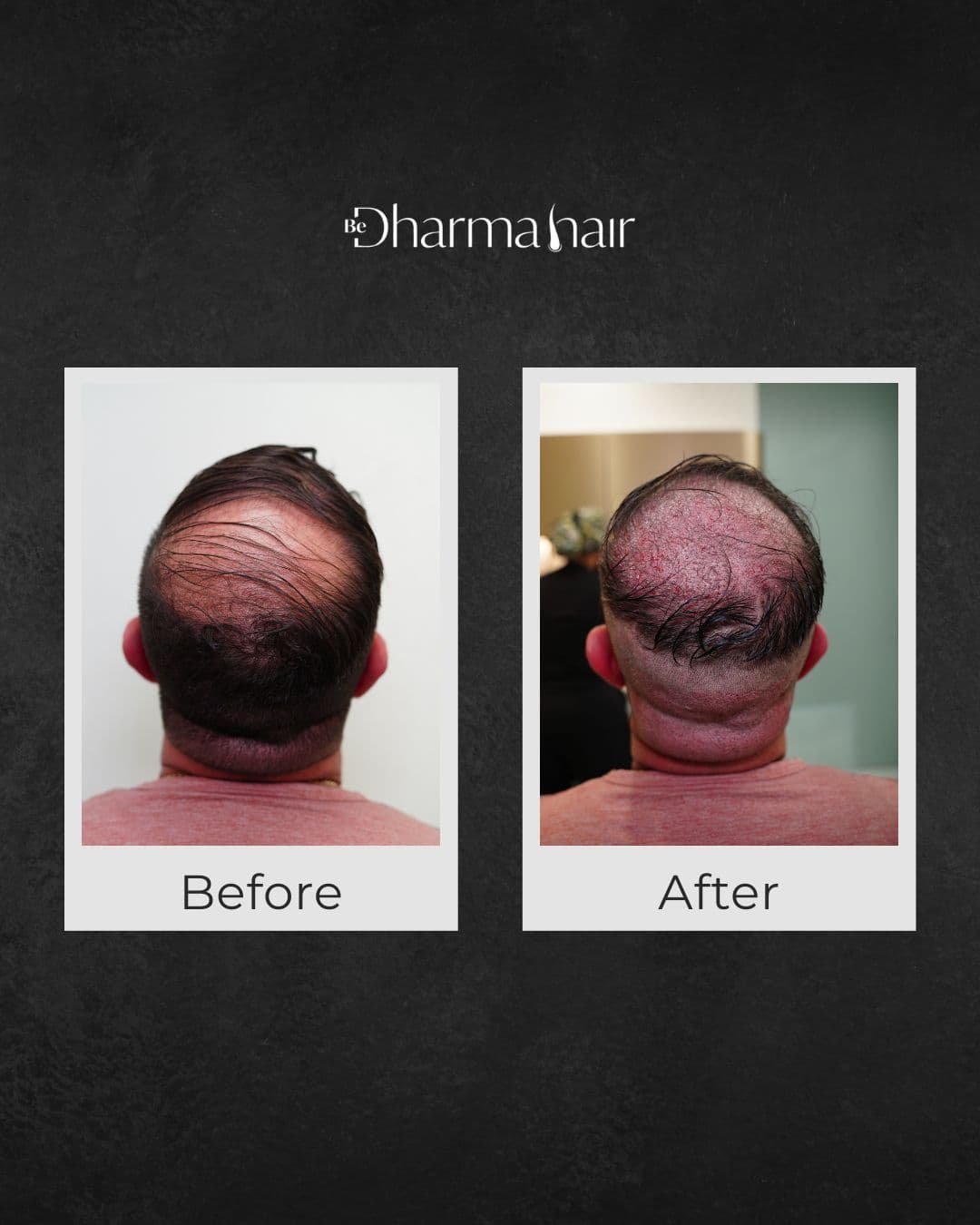 Hair implant results - Be Dharma Hair in Medellín, Colombia