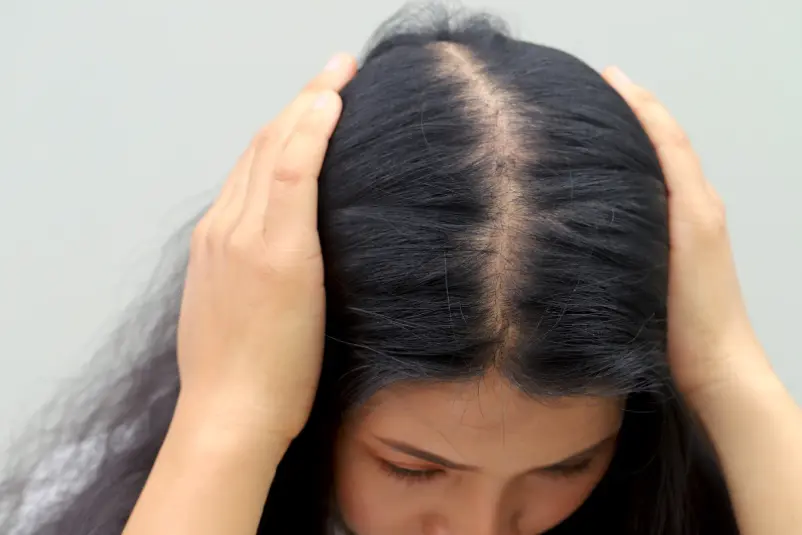 Causas de la caída del cabello en mujeres-Dharma Hair Medellín