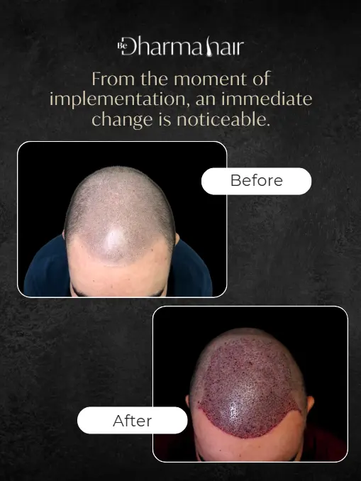 Hair implant sucess rate-Dharma Hair