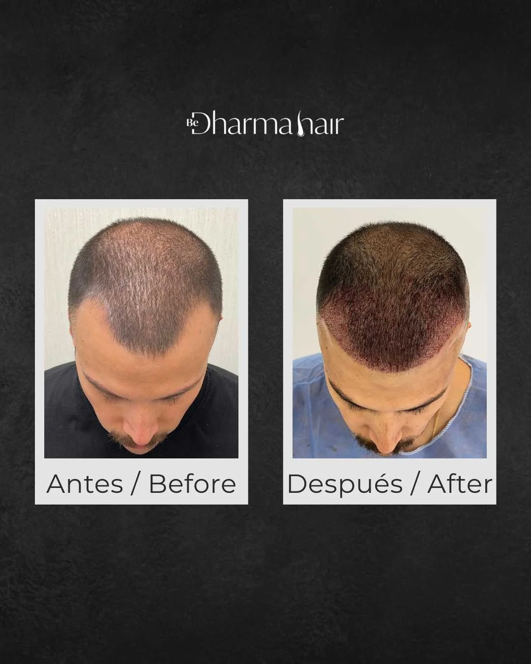 Implante-capilar-antes-y-despues-en-la-clinica-Be-Dharma-Hair-Medellin-Colombia-060426