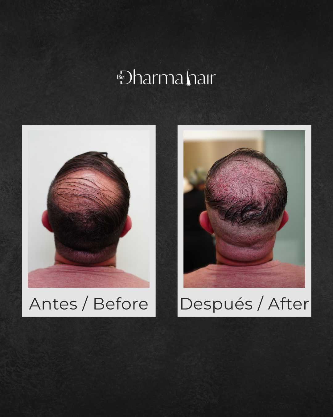Implante capilar antes y después en la clínica Be Dharma Hair - Medellín, Colombia - 060426 2
