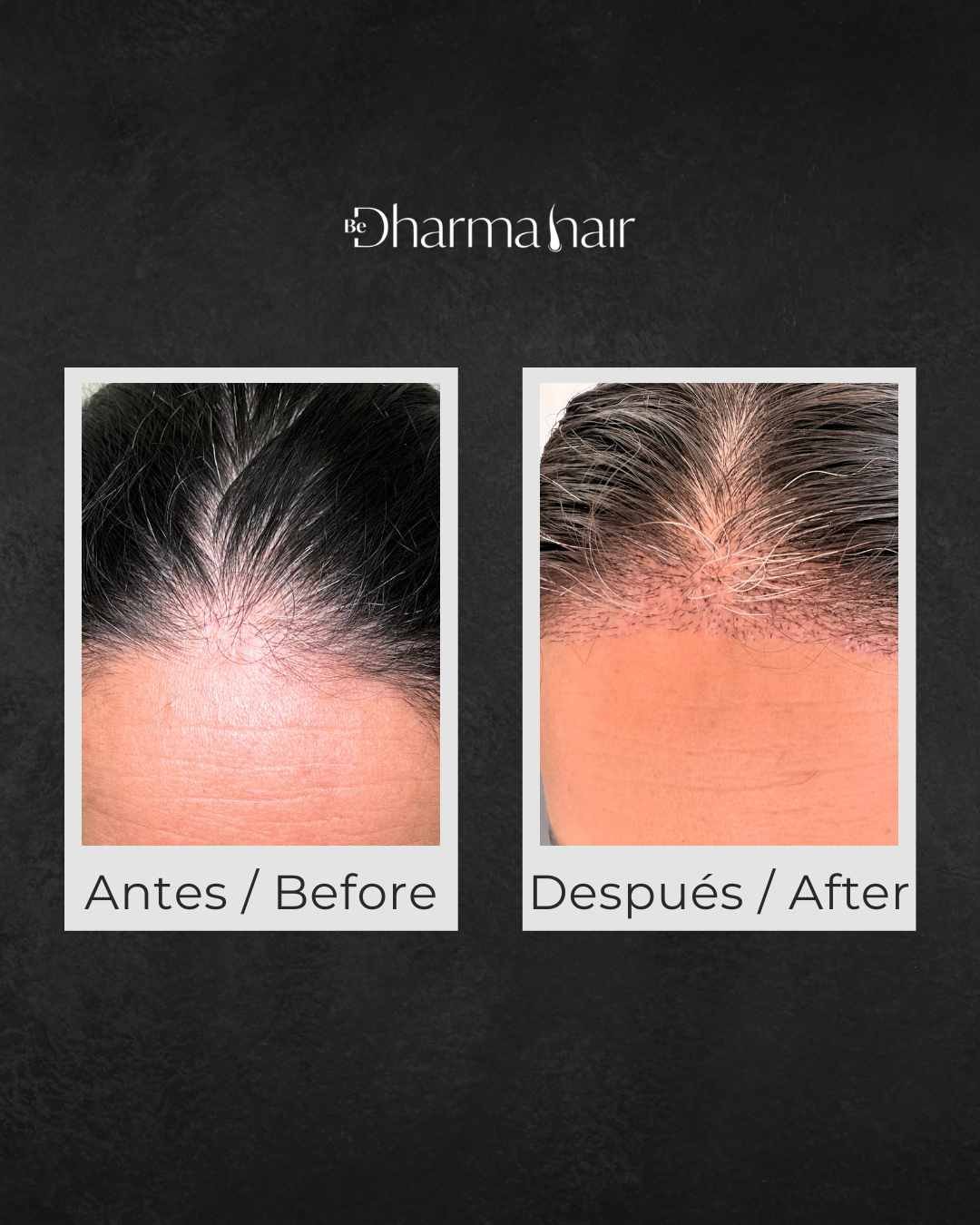 Implante capilar antes y después en mujeres en la clínica Be Dharma Hair - Medellín, Colombia - 060426 2