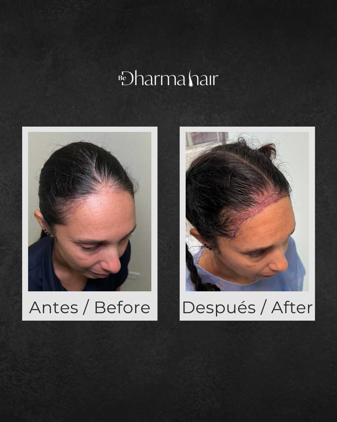Women's hair transplant before and after — Dharma Hair