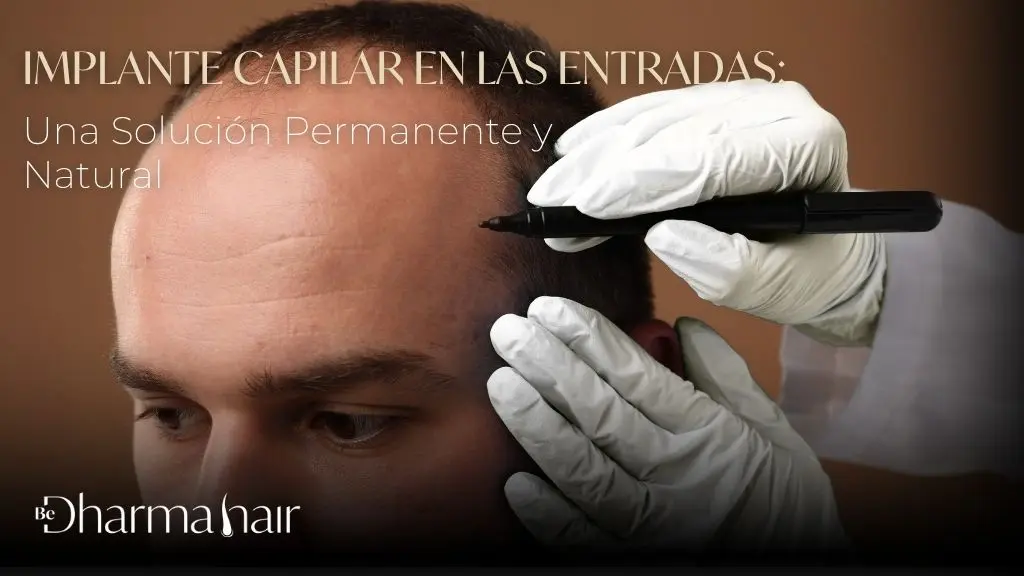 implante capilar en las entradas bedharma hair
