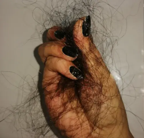 Implante capilar pelo afro- Dharma Hair