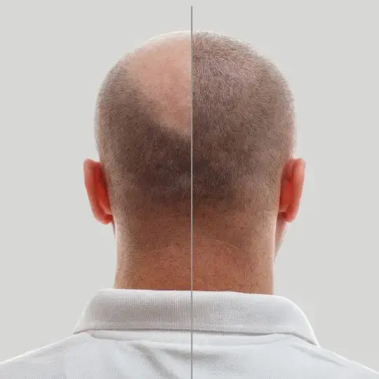 Traveling to Colombia for a FUE Hair Transplant- Choose Dharma Hair