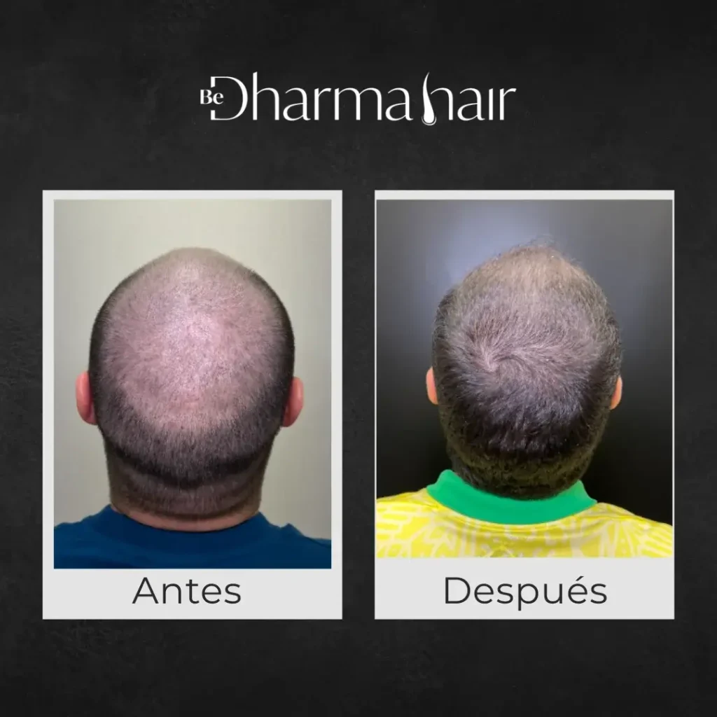 Hair Transplant month by month- Dharma Hair before anf after