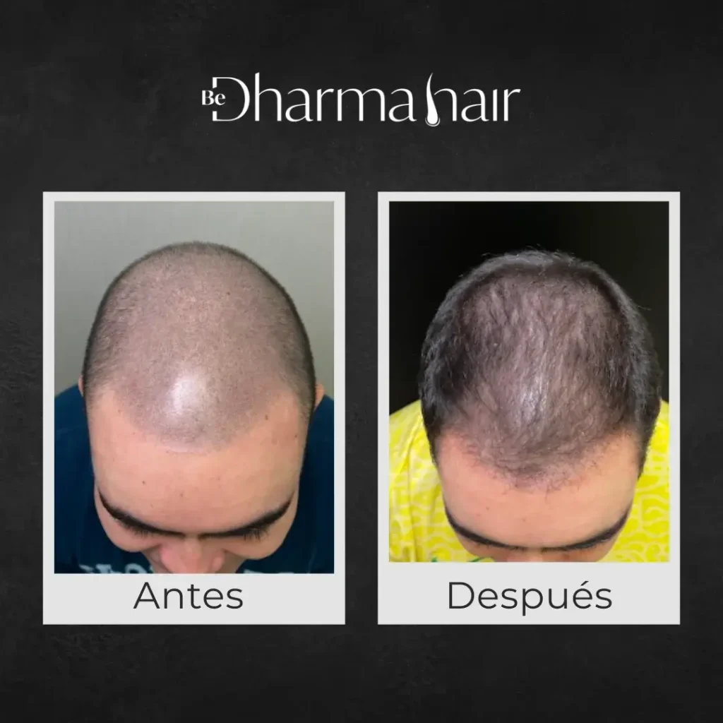 Hair Transplant month by month- Dharma Hair before anf after