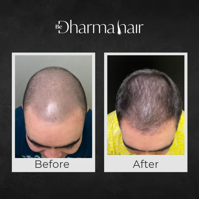 Hair Transplant in Men in Medellín- Dharma Hair- Before and after