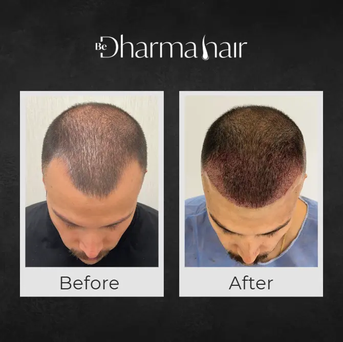 Hair Transplant in Men in Medellín- Dharma Hair- Before and after