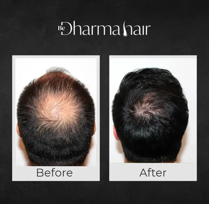 Hair Transplant in Men in Medellín- Dharma Hair- Before and after