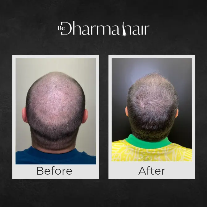 Hair Transplant in Men in Medellín- Dharma Hair- Before and after