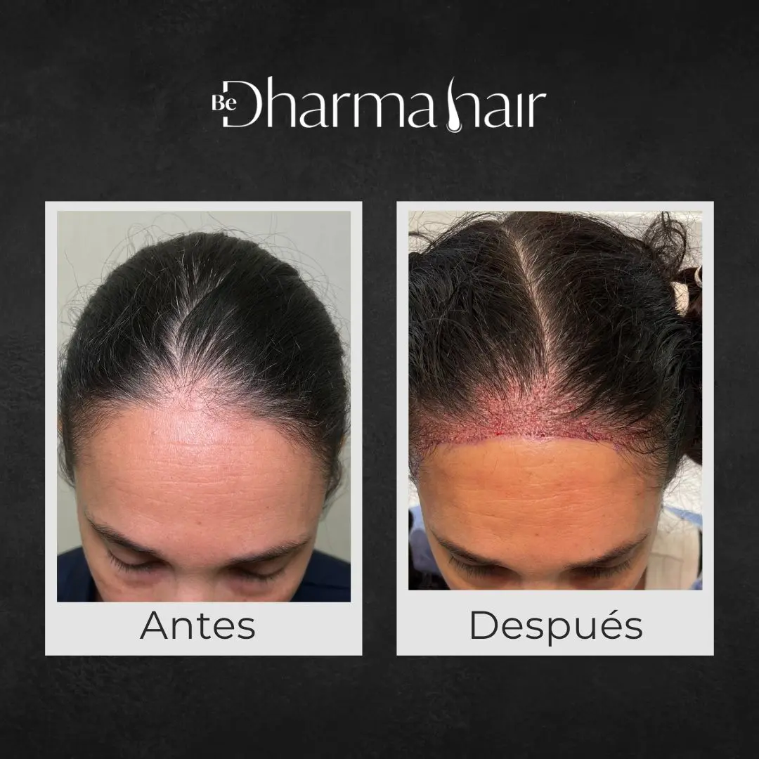 Implante capilar antes y después - Clínica de implante capilar Be Dharma Hair - Medellín, Colombia en mujer