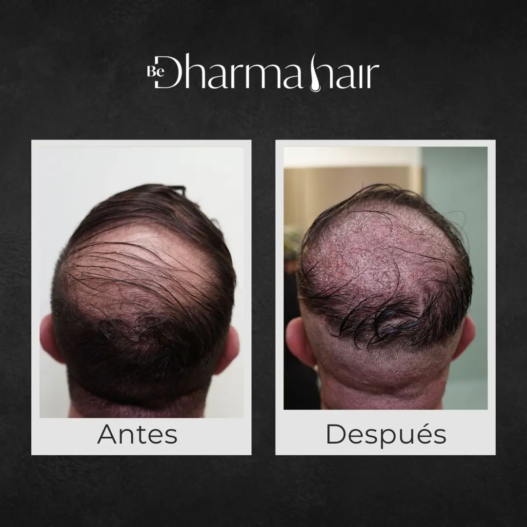 Implante capilar antes y después - corona - Clínica de implante capilar Be Dharma Hair - Medellín, Colombia