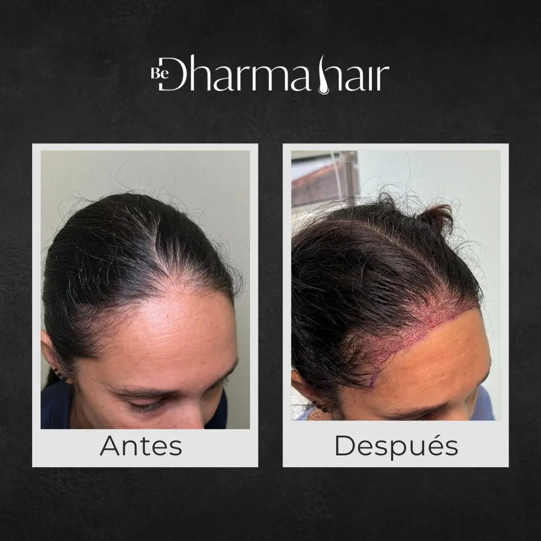 Implante capilar en mujer antes y después - Clínica de implante capilar Be Dharma Hair - Medellín, Colombia