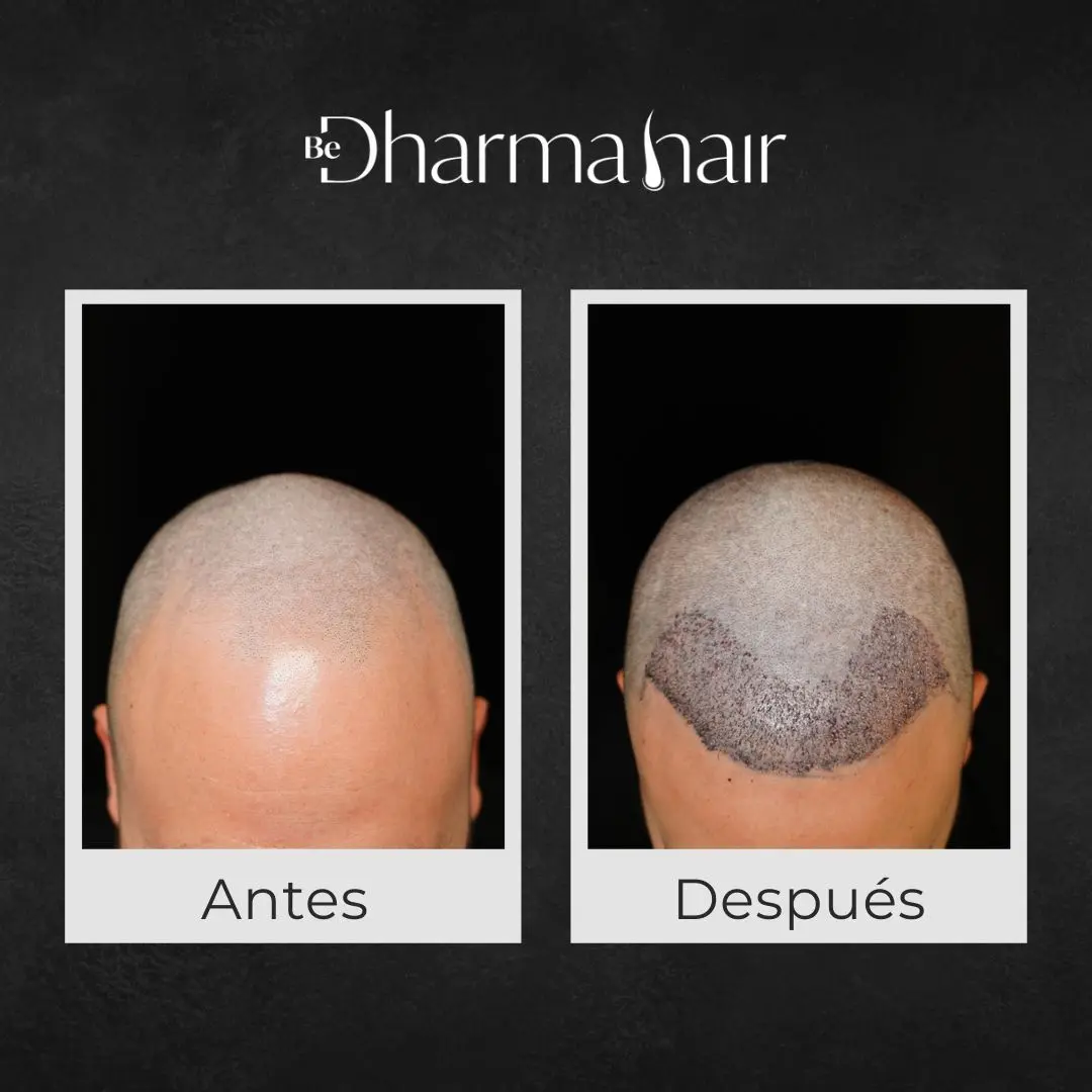 Implante capilar robótico antes y después - Clínica de implante capilar Be Dharma Hair - Medellín, Colombia 060826
