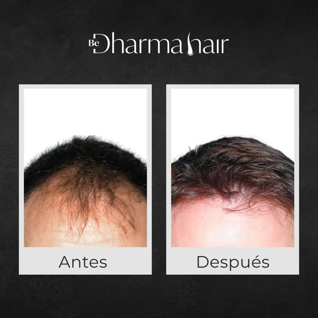 Implante capilar robótico antes y después - Clínica de implante capilar Be Dharma Hair - Medellín, Colombia 1