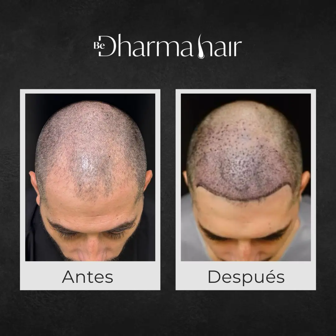 Implante capilar robótico antes y después - Clínica de implante capilar Be Dharma Hair - Medellín, Colombia 230626