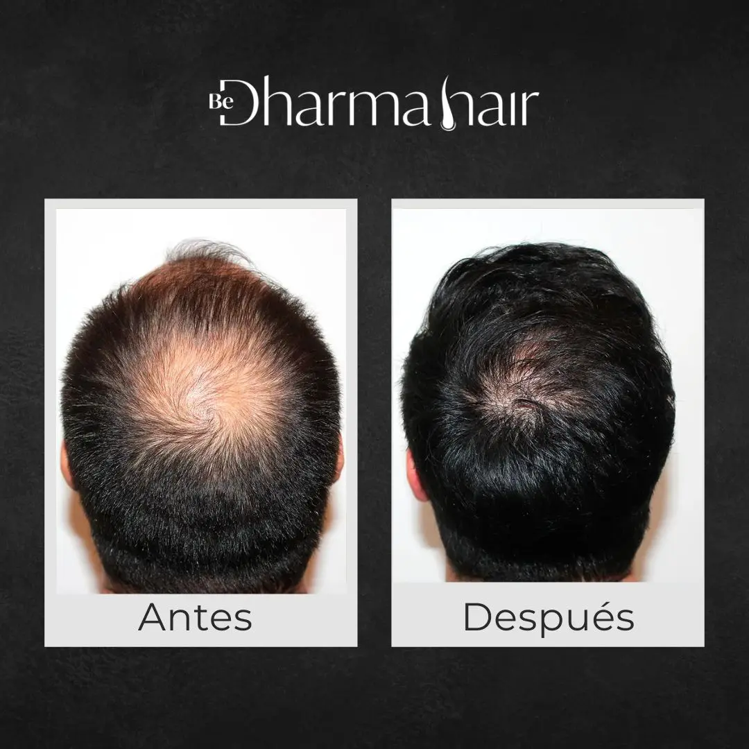 Implante capilar robótico antes y después - Clínica de implante capilar Be Dharma Hair - Medellín, Colombia