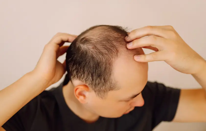 Qué sirve para la calvicie en el hombre- Dharma Hair