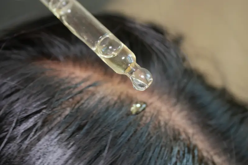 Qué sirve para la calvicie en el hombre-Minoxidil- Dharma Hair