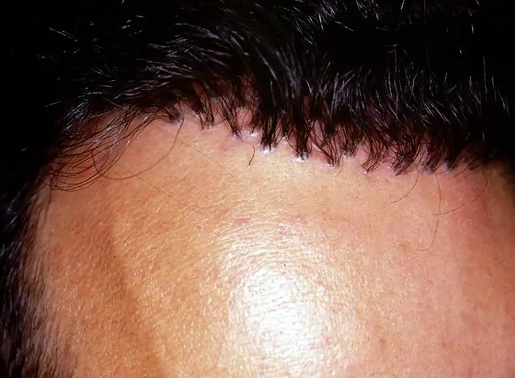 Evolución del implante capilar- Dharma Hair